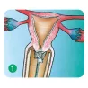 BALAI ENDOCERVICAL